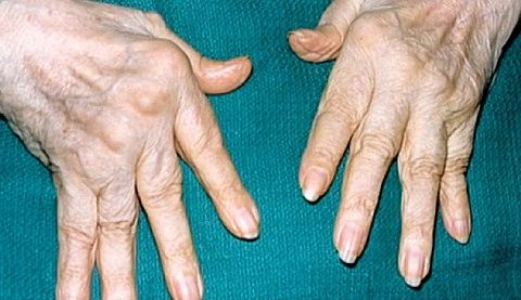 כאב במפרקים של האצבעות