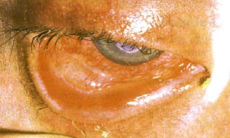 תסמונת סטיבנס-ג'ונסון.  דו-צדדית דלקתית דו-צדדית עם אזורים של נמק.  קרטיטיס כבדה, שגרמה להופעת צלקות על הקרנית.  המצב היה מסובך על ידי תוספת של תסמונת העיניים 
