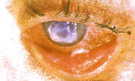תסמונת סטיבנס-ג'ונסון.  דו-צדדית דלקתית דו-צדדית עם אזורים של נמק.  קרטיטיס כבדה, שגרמה להופעת צלקות על הקרנית.  המצב היה מסובך על ידי תוספת של תסמונת העיניים 