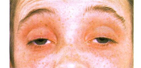 Ophthalmoplegia חיצוני.  פטוזה דו צדדית.  המטופל פוקח את עיניו בהרים את גבותיו